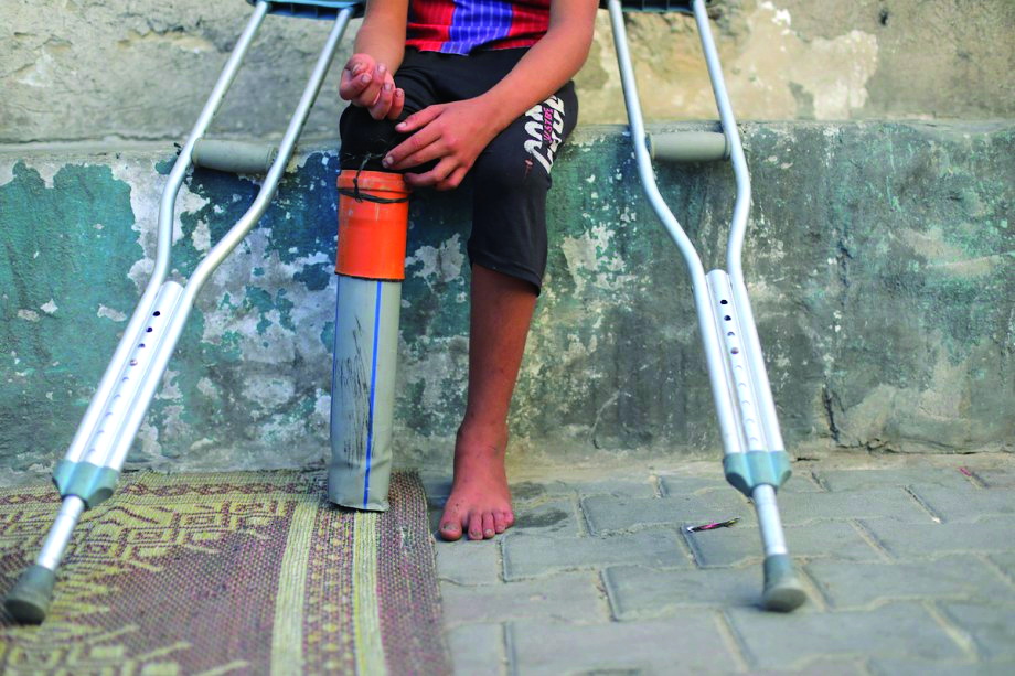 આરોગ્ય મંત્રાલય કહે છે કે ગાઝામાં હવે વિશ્વનો સૌથી વધુ બાળ અંગવિચ્છેદન દર છે